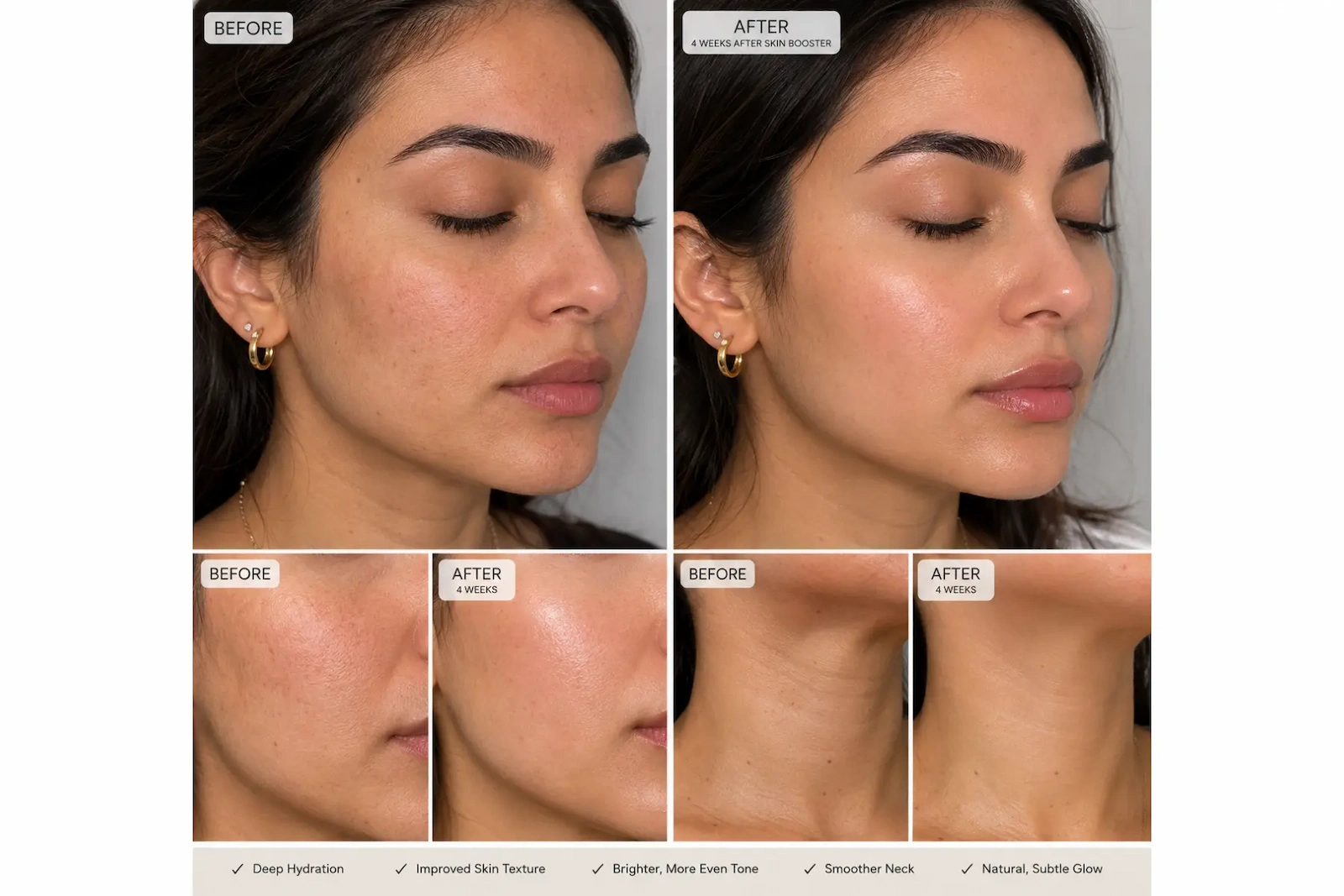 Before and after 4 weeks of skin booster treatment
